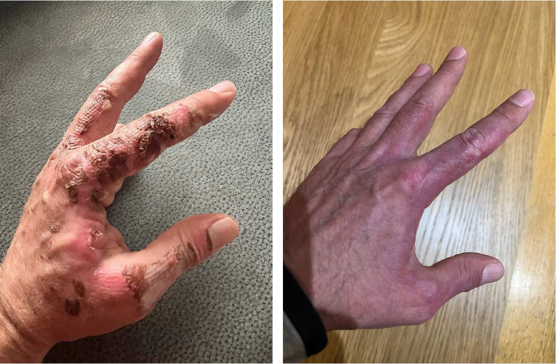 Wie Sauerstoff bei Hautverbrennungen eingesetzt wird