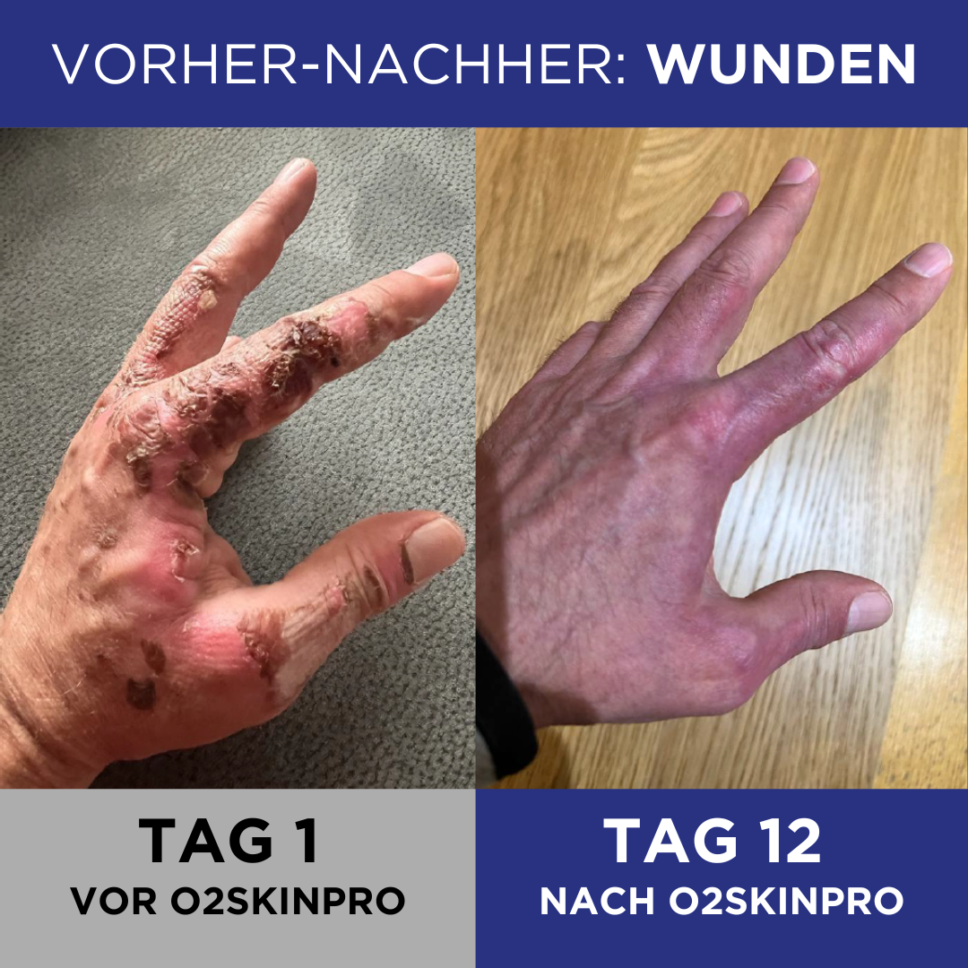 O2SkinPro mit 100% Sauerstoff 60ml Verbrennung Hand vorher und nachher