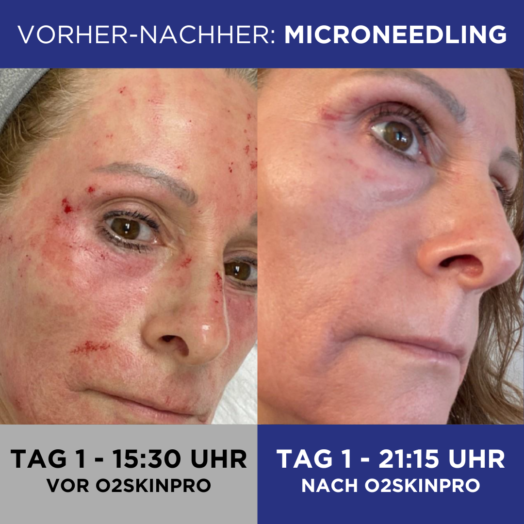 Analyzing image 11_3 1080 × 1080 Pixel O2SkinPro mit 100% Sauerstoff 60ml Microneedlung vorher nachher